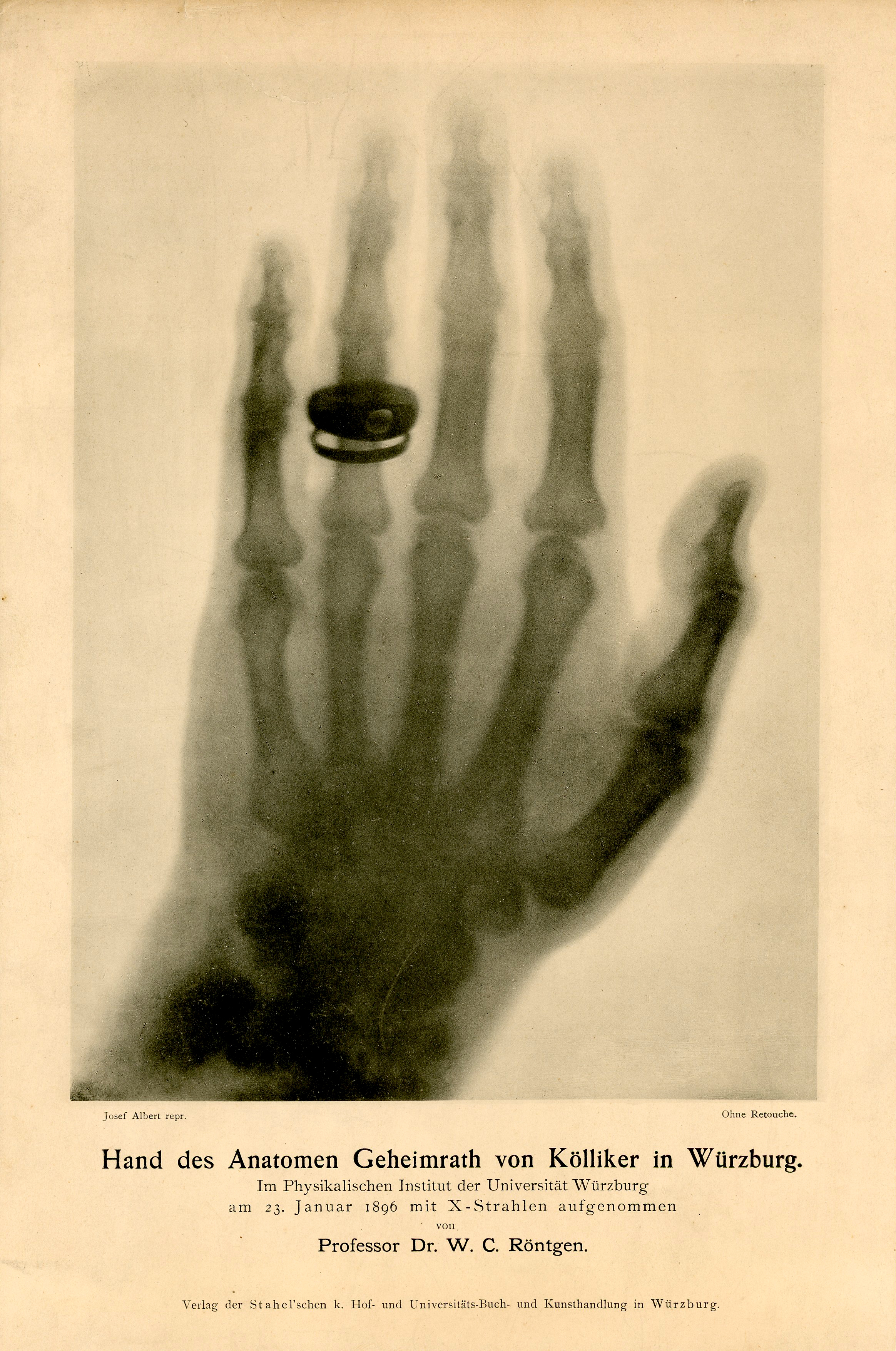 X-ray of a man's hand