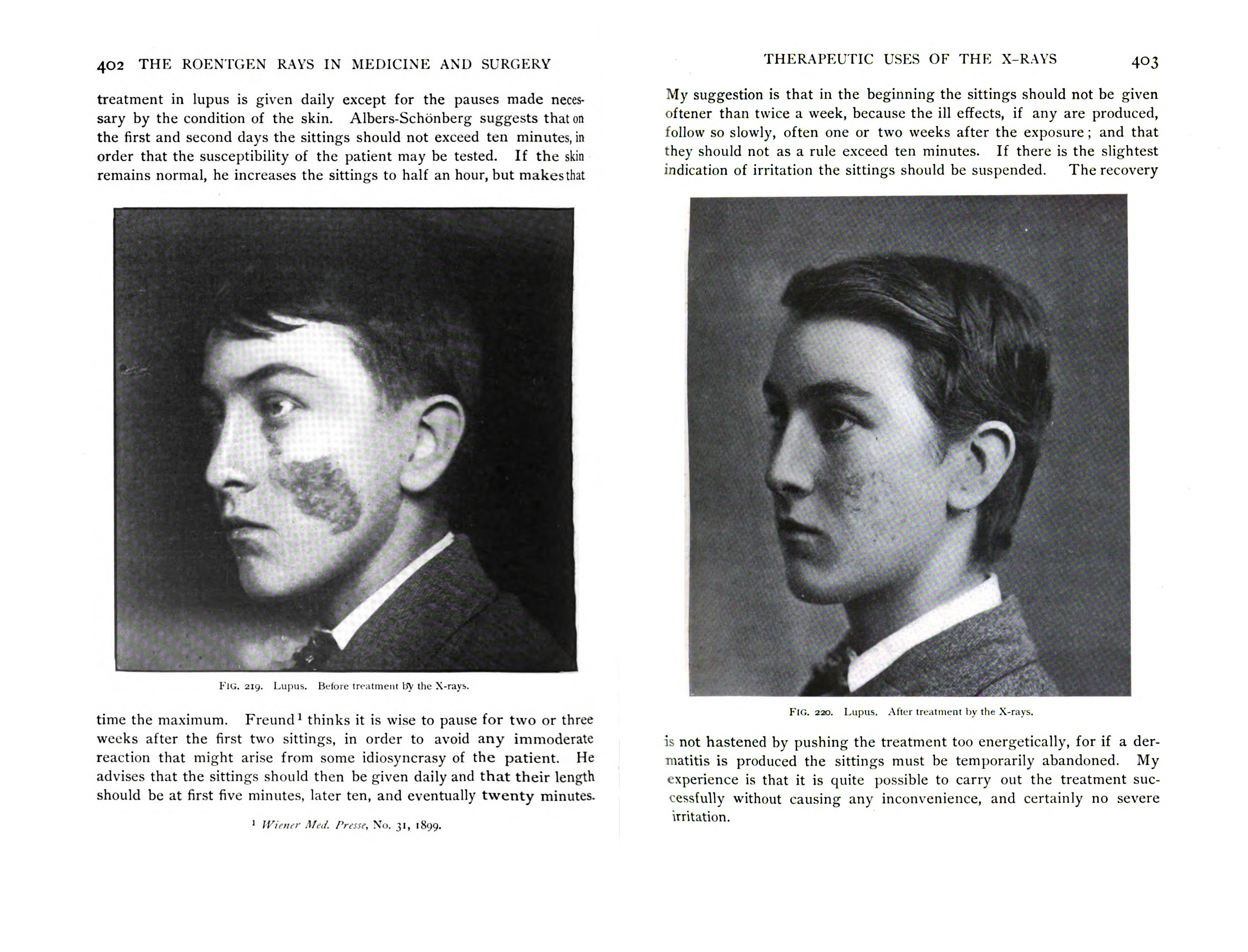 Before and after photos of a boy treated for lupus with radiation