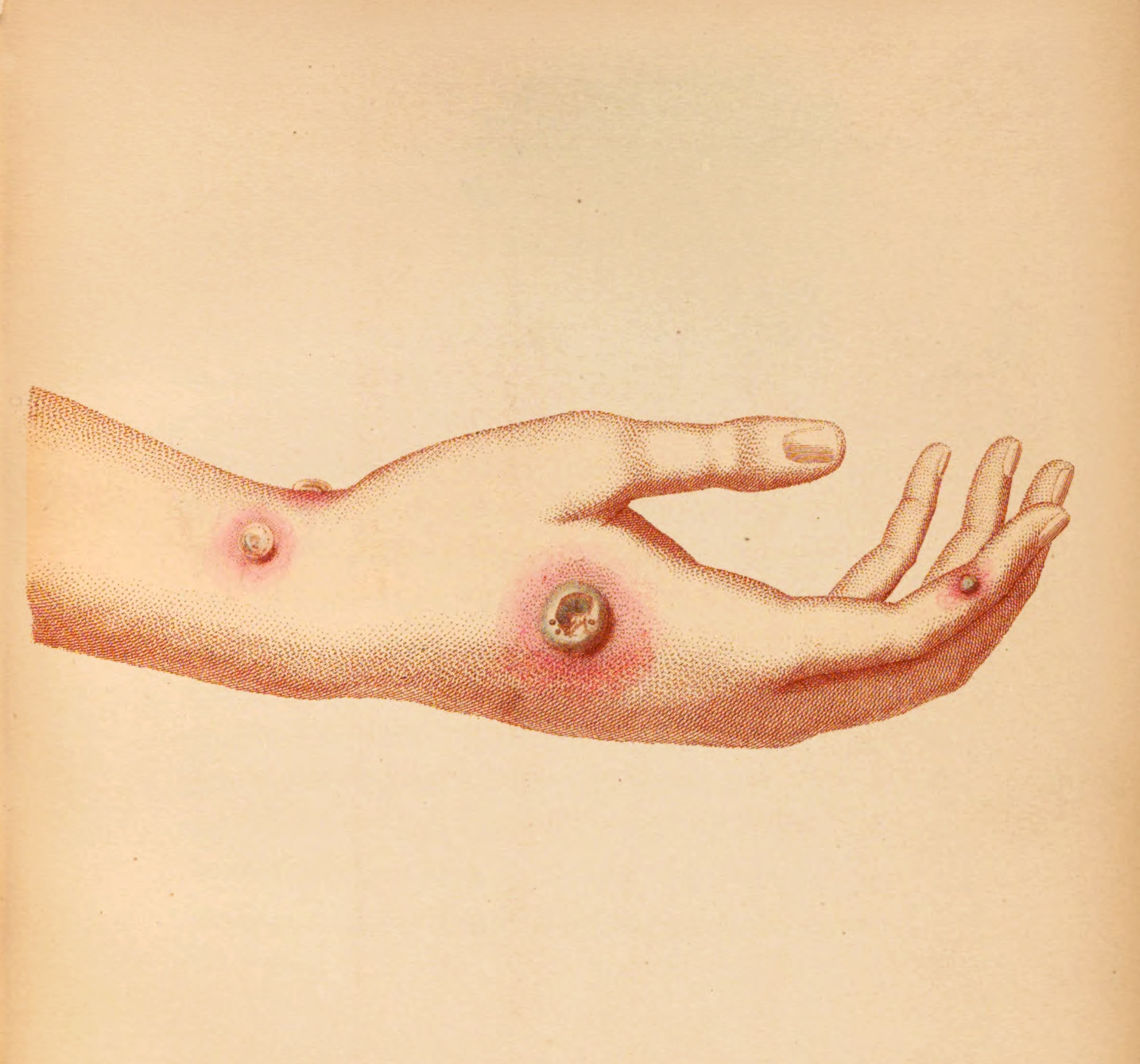 Illustration of a woman's hand with cowpox blisters