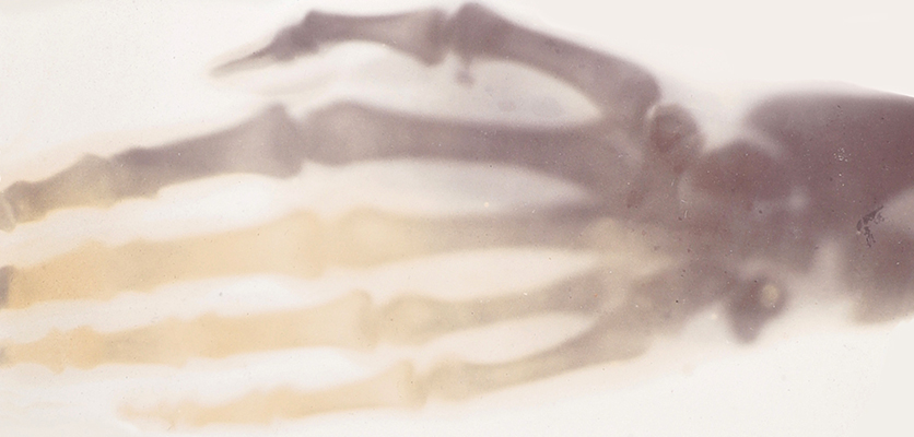 X-ray of a human hand