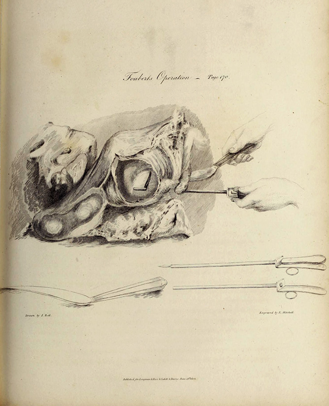 Engraving of Fouberts operation by John Bell