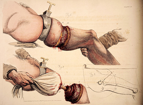 Engraving depicting knee amputation