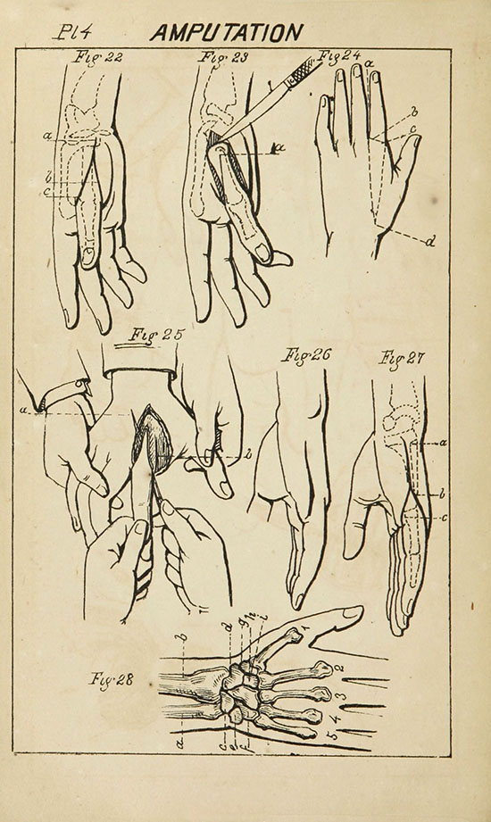 illustrations of various finger amputation techniques, such as the removal of the second metacarpal by the oval method
