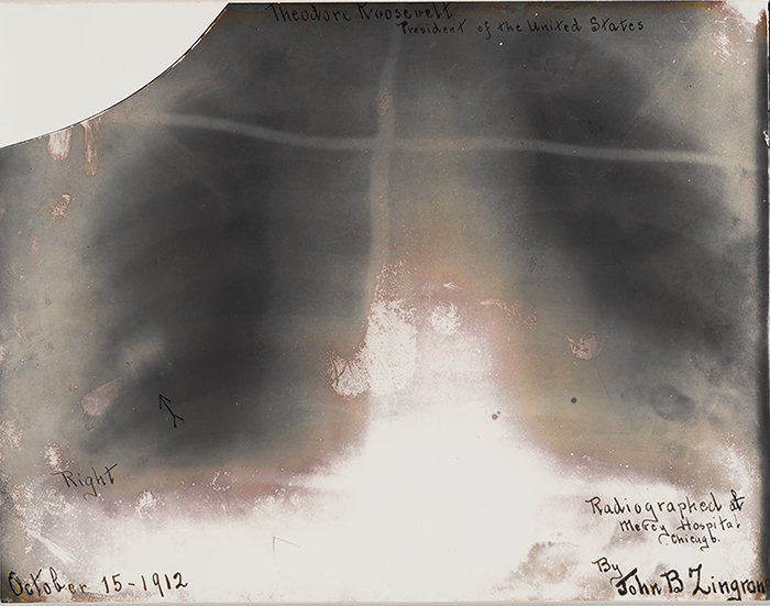Roosevelt's chest x-ray